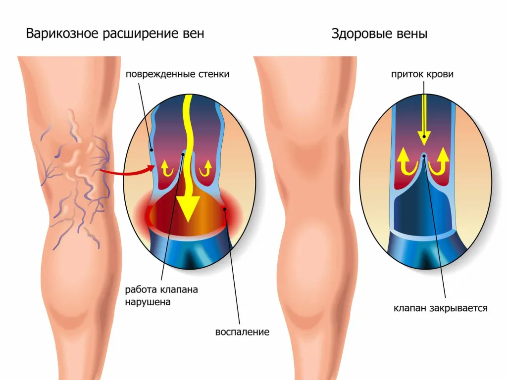 Варикозное расширение вен у детей