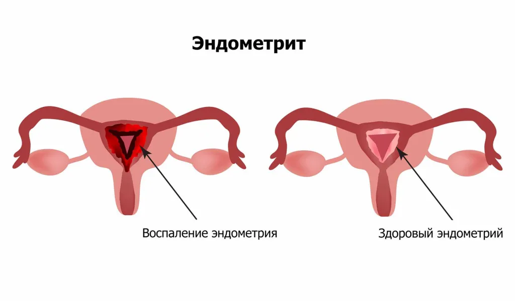 Эндометрит у детей