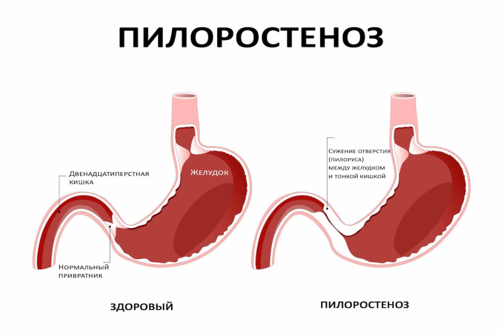 Пилоростеноз