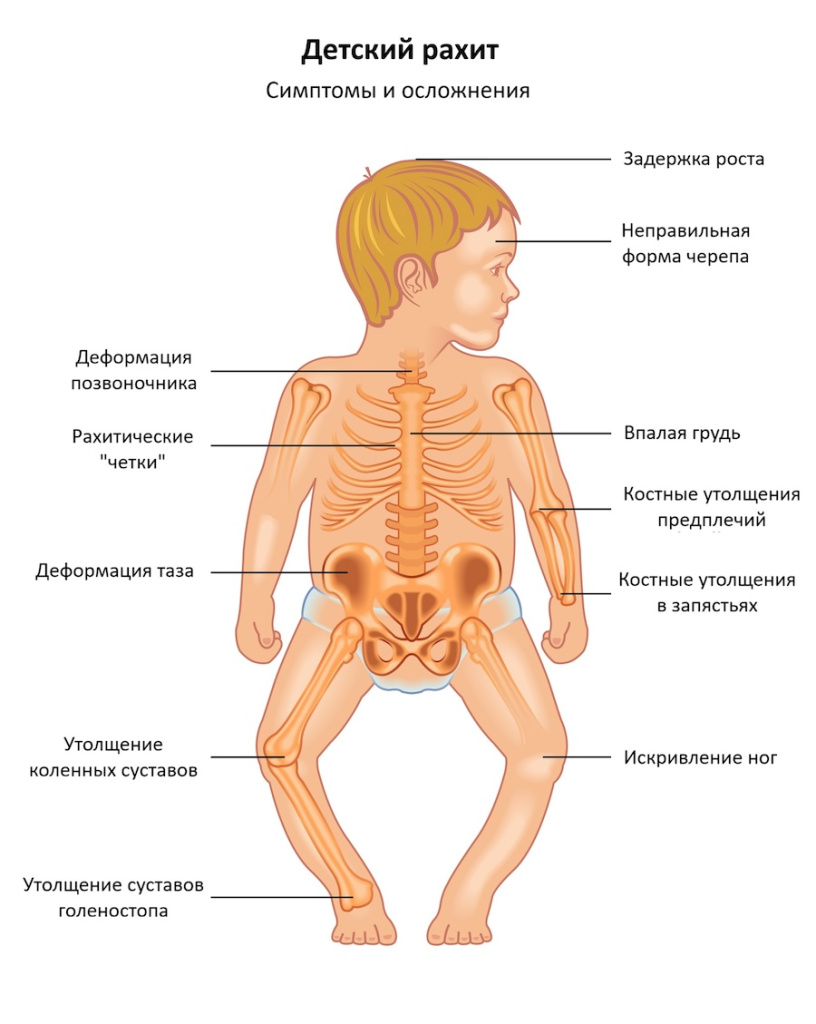 Детский рахит 