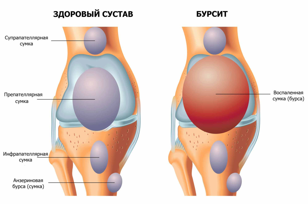 Бурсит коленного сустава