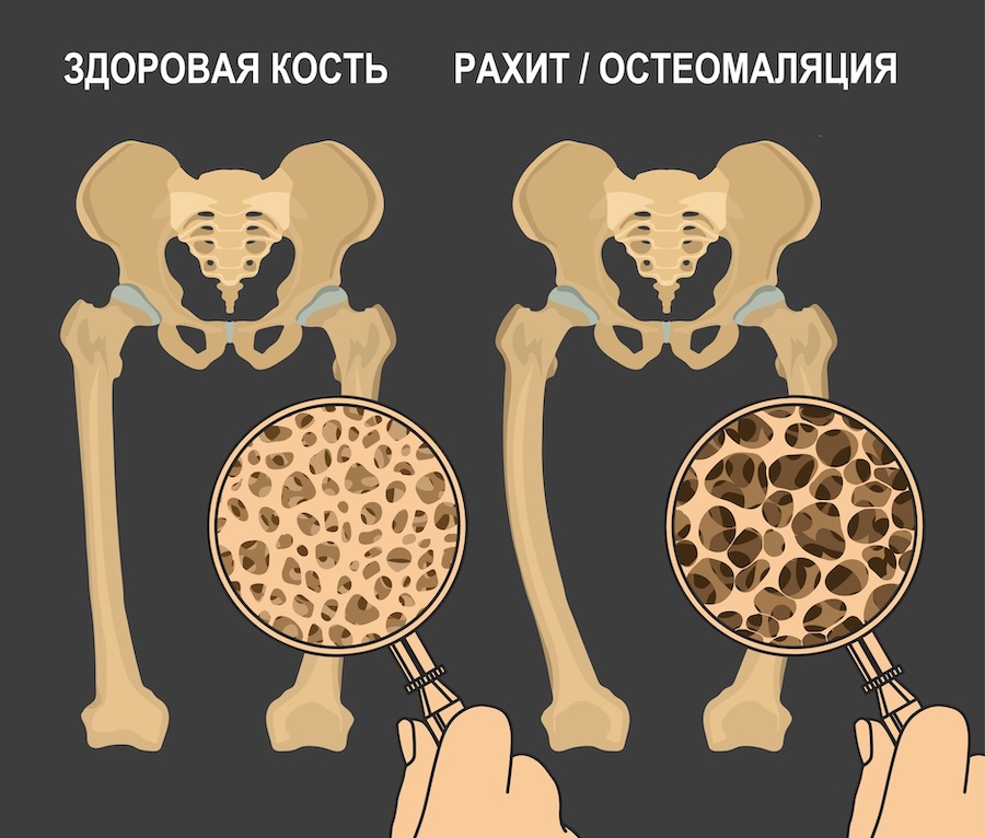 Рахит